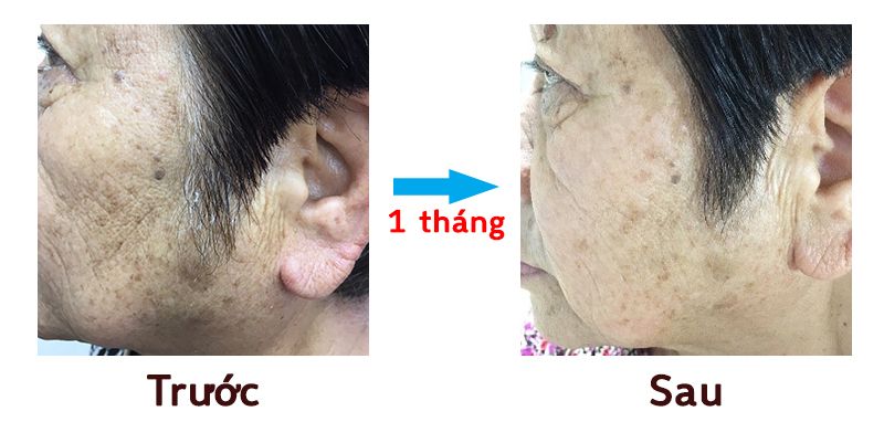 Hiệu quả của kem dưỡng trắng da Sakura Kosumeru Hiệu quả của kem dưỡng trắng da Sakura Kosumeru